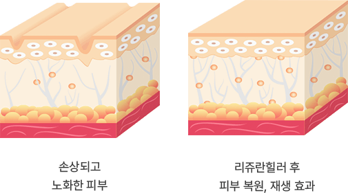 리쥬란힐러